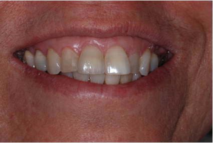 After: restored upper front teeth in a natural-looking smile