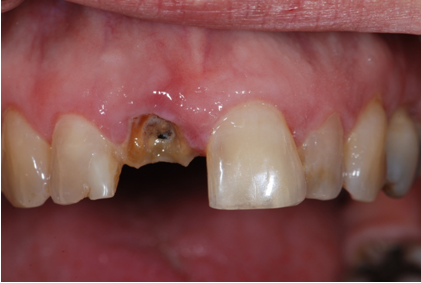 Before: badly decayed, broken-down upper front tooth beside a healthy front tooth