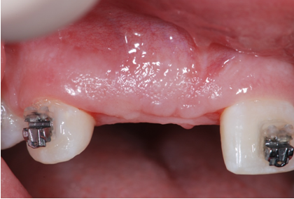 Before: missing upper front teeth leaving a gap in the gum ridge between two braced teeth