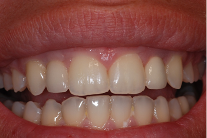 After: gaps closed with a complete row of natural-looking upper teeth